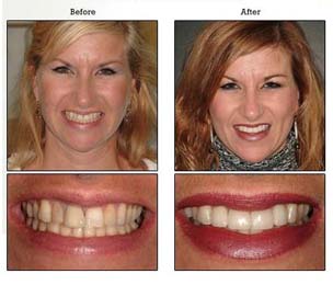 before and after teeth whitening image